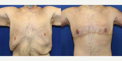 Case 8767 - 25-34 year old man treated with Gynecomastia Surgery