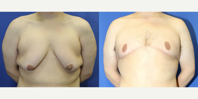 Case 8769 - 18-24 year old man treated with Gynecomastia Surgery