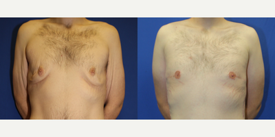 Case 8770 - 35-44 year old man treated with Gynecomastia Surgery