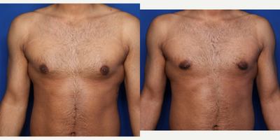 Case 8771 - 25-34 year old man treated with Gynecomastia Surgery