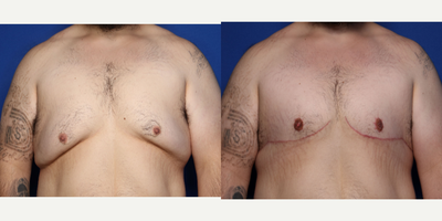 Case 8773 - 25-34 year old man treated with Gynecomastia Surgery