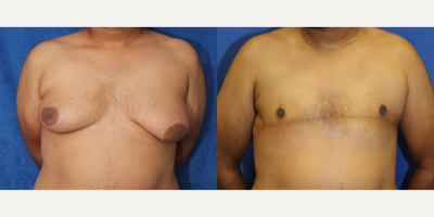 Case 8774 - 25-34 year old man treated with Gynecomastia Surgery