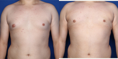 Case 8775 - 18-24 year old man treated with Gynecomastia Surgery