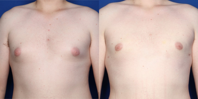 Case 8776 - 18-24 year old man treated with Gynecomastia Surgery