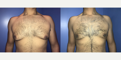 Case 8778 - Man treated with Gynecomastia Surgery