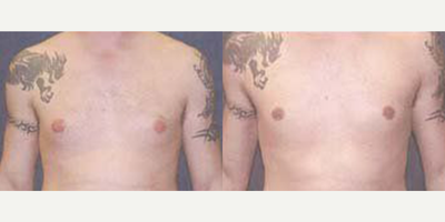 Case 8779 - 18 year old man treated with Gynecomastia Surgery