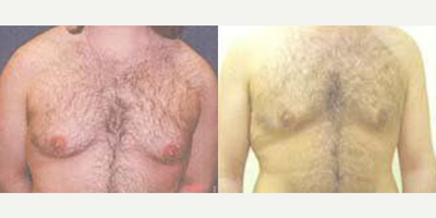 Case 8781 - 36 year old man treated with Gynecomastia Surgery