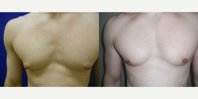Case 8782 - 30 year old man treated with Gynecomastia Surgery