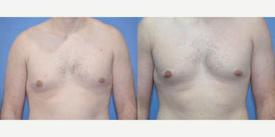 Case 8783 - Woman treated with Gynecomastia Surgery