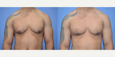 Case 8784 - Woman treated with Gynecomastia Surgery
