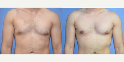 Case 8785 - Woman treated with Gynecomastia Surgery