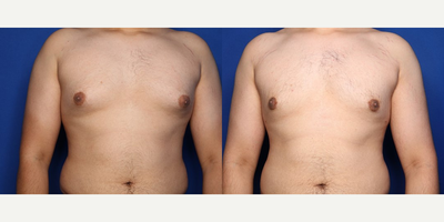 Case 8786 - 18-24 year old man treated with Gynecomastia Surgery