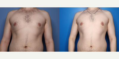 Case 8787 - 24 year old man treated with Gynecomastia Surgery