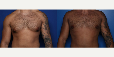 Case 8788 - 29 year old man treated with Gynecomastia Surgery