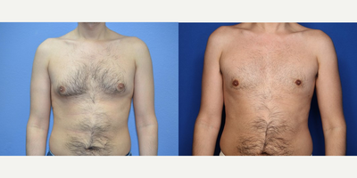 Case 8789 - 27 year old man treated with Gynecomastia Surgery