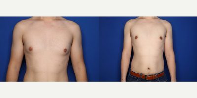 Case 8790 - Man treated with Gynecomastia Surgery