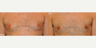 Case 8791 - Man treated with Gynecomastia Surgery