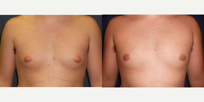 Case 8792 - 18 year old man treated with Gynecomastia Surgery