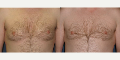 Case 8793 - 39 year old man treated with Gynecomastia Surgery