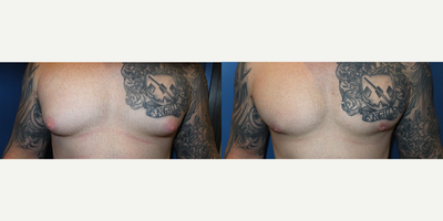 Case 8794 - Man treated with Gynecomastia Surgery