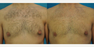 Case 8798 - Woman treated with Gynecomastia Surgery