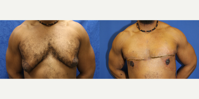 Case 8799 - 25-34 year old man treated with Gynecomastia Surgery