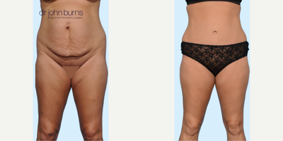 Case 88 - Woman treated with Tummy Tuck