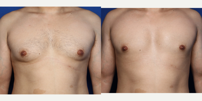 Case 8800 - 35-44 year old man treated with Gynecomastia Surgery