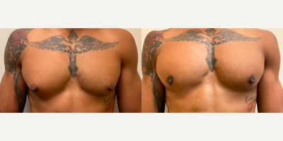Case 8801 - Woman treated with Gynecomastia Surgery