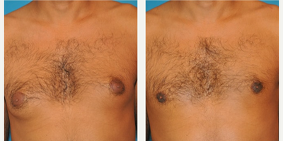 Case 8802 - Man treated with Gynecomastia Surgery