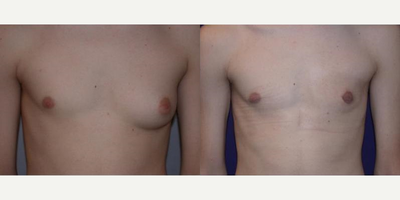 Case 8803 - Woman treated with Gynecomastia Surgery