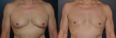 Case 8804 - 50 year old woman treated with Liposuction, Gynecomastia Surgery
