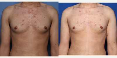 Case 8805 - 18-24 year old man treated with Gynecomastia Surgery