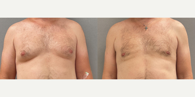 Case 8806 - 45-54 year old man treated with Gynecomastia Surgery
