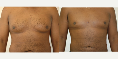Case 8807 - 35-44 year old man treated with Gynecomastia Surgery