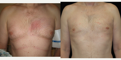 Case 8808 - 35-44 year old man treated with Gynecomastia Surgery