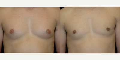 Case 8809 - 25-34 year old man treated with Gynecomastia Surgery