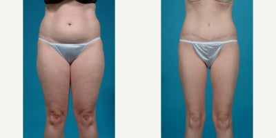 Case 881 - 25-34 year old woman treated with Abdominal Etching, Diastasis Recti Repair, Drainless Tummy Tuck, Liposculpture, Liposuction, M