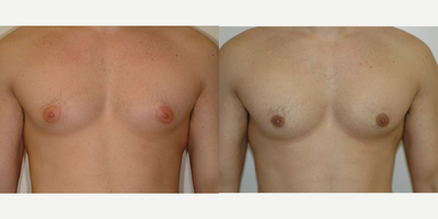 Case 8810 - 25-34 year old man treated with Gynecomastia Surgery