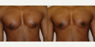 Case 8811 - 25-34 year old man treated with Gynecomastia Surgery