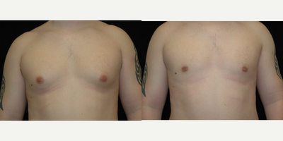 Case 8812 - 25-34 year old man treated with Gynecomastia Surgery