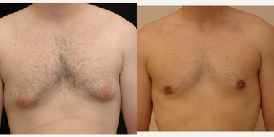 Case 8813 - 25-34 year old man treated with Gynecomastia Surgery