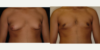 Case 8814 - 18-24 year old man treated with Gynecomastia Surgery