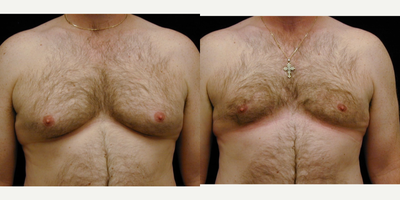 Case 8815 - 25-34 year old man treated with Gynecomastia Surgery