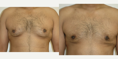 Case 8816 - 25-34 year old man treated with Gynecomastia Surgery