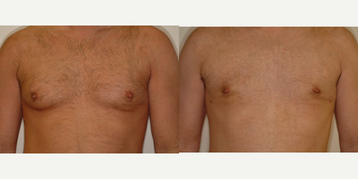 Case 8817 - 25-34 year old man treated with Gynecomastia Surgery