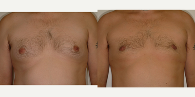 Case 8818 - 25-34 year old man treated with Gynecomastia Surgery