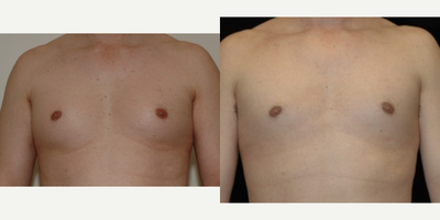 Case 8819 - 25-34 year old man treated with Gynecomastia Surgery