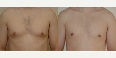 Case 8820 - 25-34 year old man treated with Gynecomastia Surgery