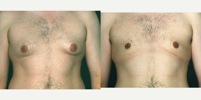 Case 8821 - 25-34 year old man treated with Gynecomastia Surgery